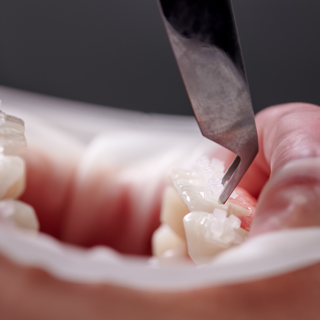 Dental specialist attaching white braces to patient teeth.