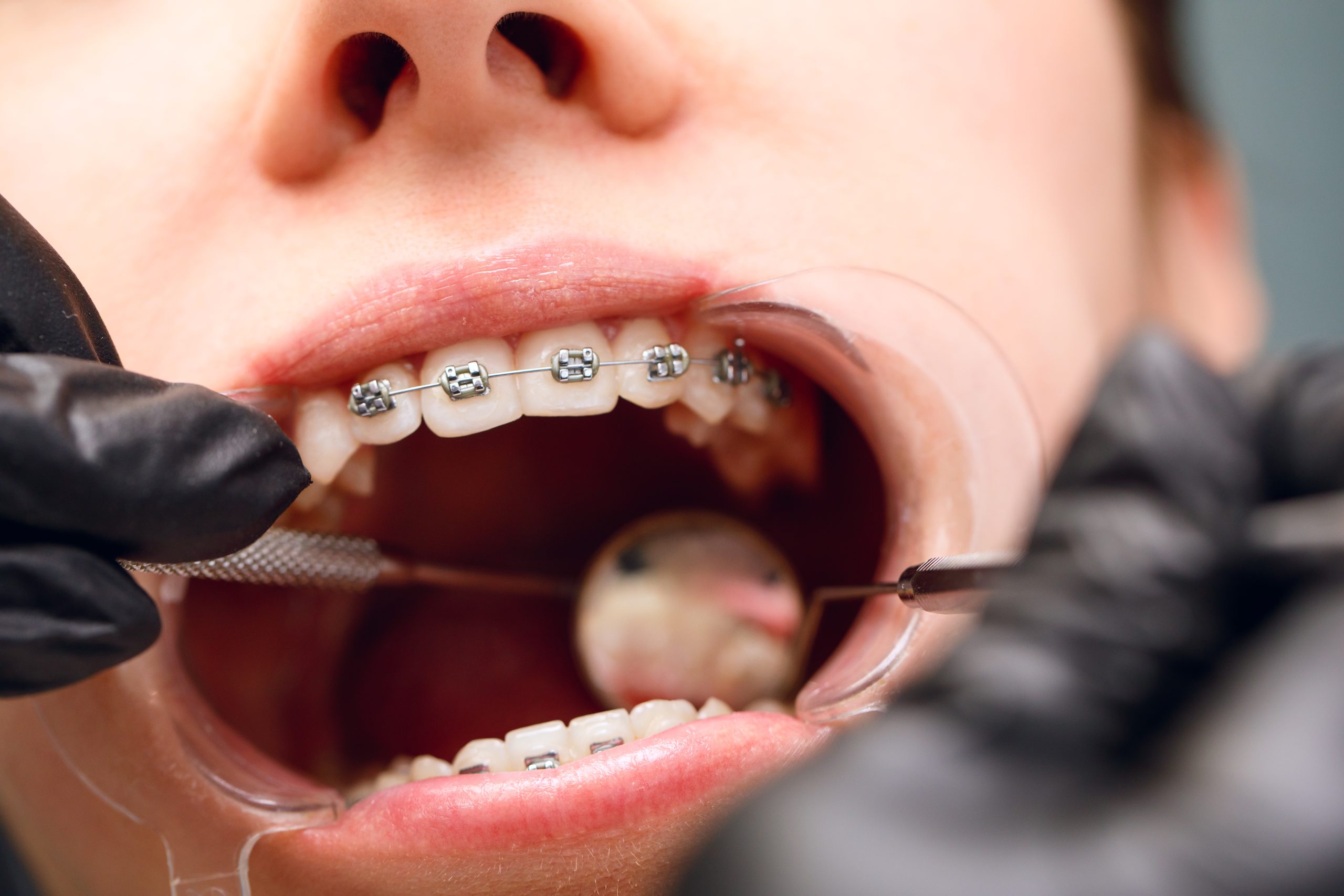 A young woman with metal braces is being examined by an orthodontist. Correction of the bite of teeth in the dental clinic. Concept of healthy teeth.
